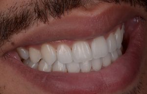 Invisalign Results