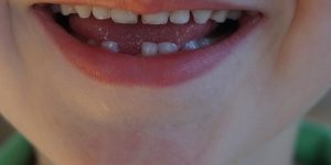 Childrens Teeth