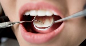 Mouth Cancer