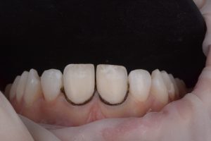 Gum prep