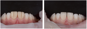 Veneers