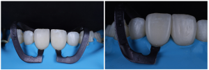 Close up of veneers