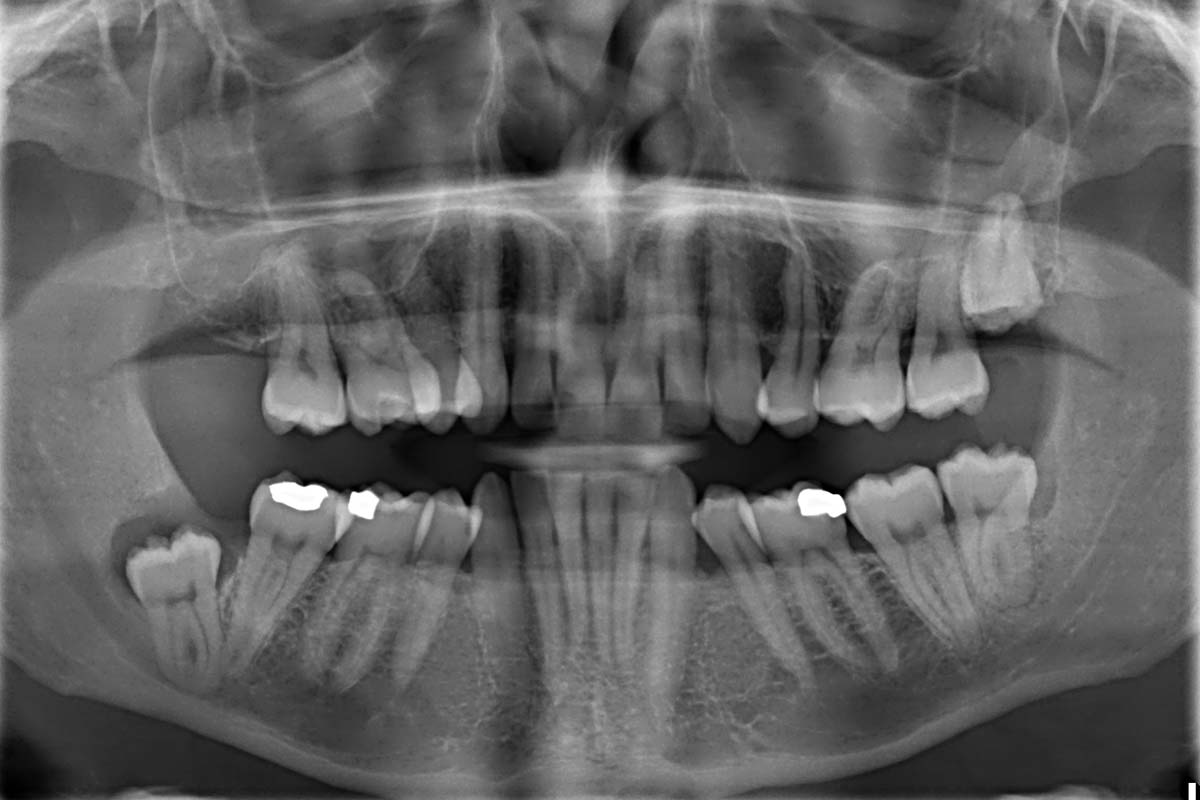Are dental x-rays safe?