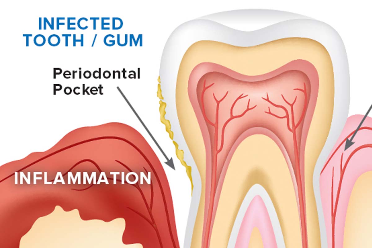 Understanding gum disease