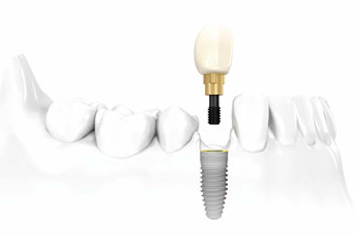 The ultimate guide to dental implants