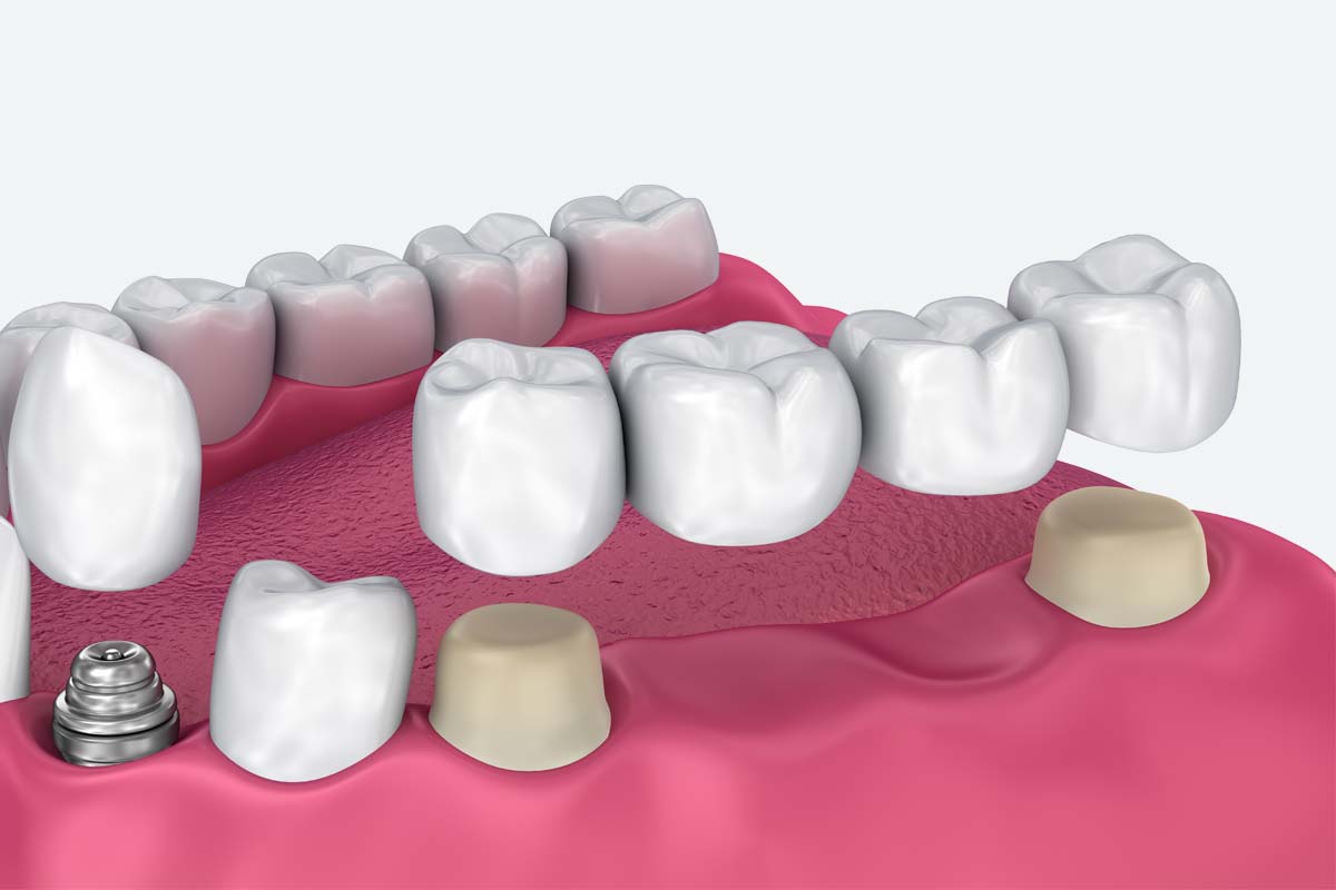 The pros and cons of dental bridges