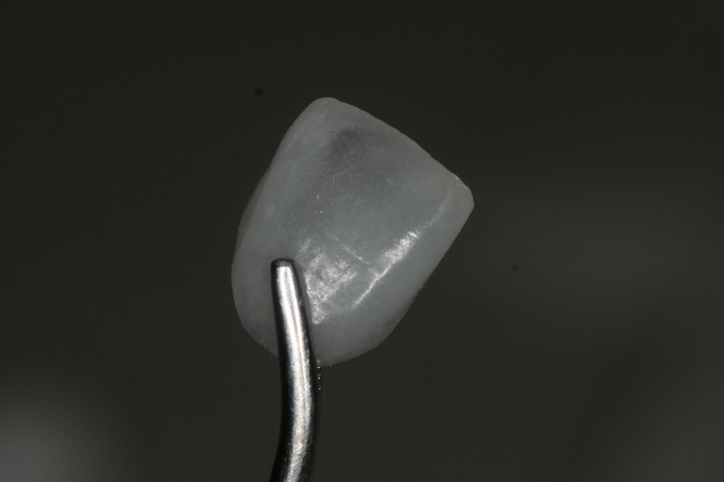 Dental veneers
