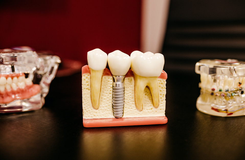 Root Canal vs Extraction: What's the Difference?