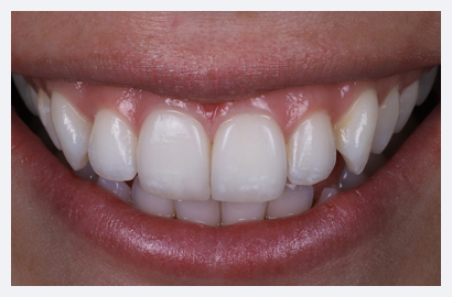 Veneers: Step-By-Step