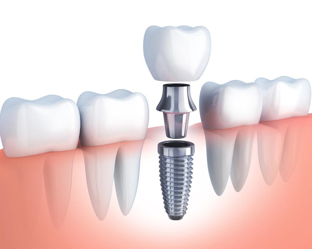 How Do Dental Implants Work?