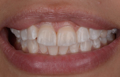 Whitening and composite bonding