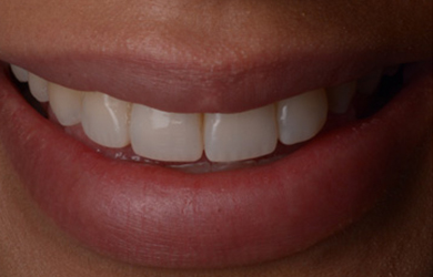 Invisalign and composite bonding