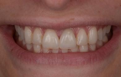 Whitening and Veneers