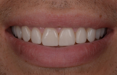 Veneers