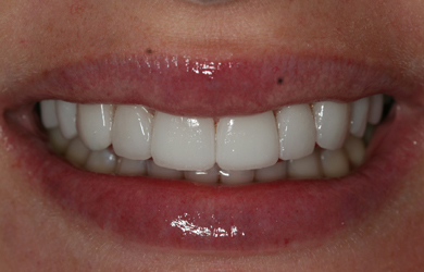 Veneers