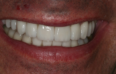 Veneers