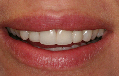 Veneers
