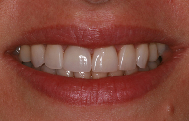 Veneers