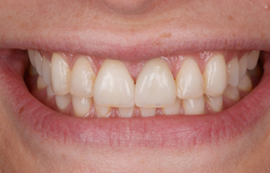 Veneers