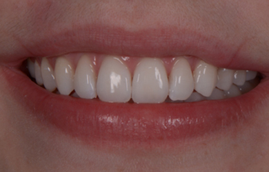 Invisalign