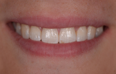 Invisalign