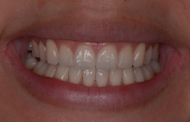 Invisalign