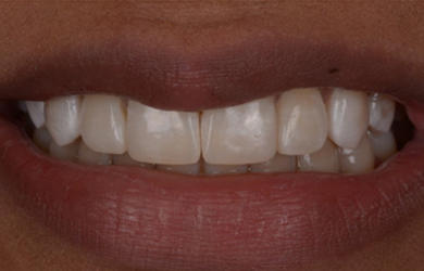 Invisalign