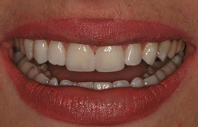 Whitening