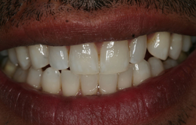 Whitening
