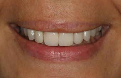 Whitening