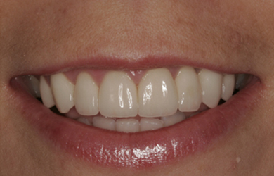 Whitening