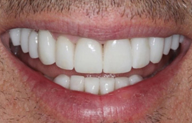 Smile Makeover