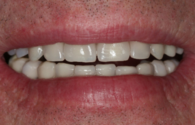 Smile Makeover