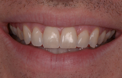 Fixed Braces