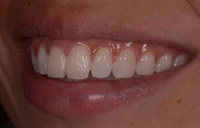 Fixed Braces
