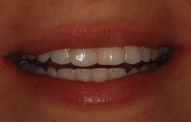 Inman Aligner