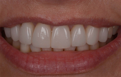 Invisalign and Veneers