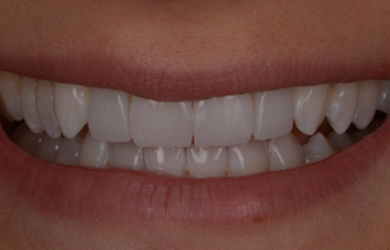 Composite Bonding