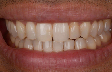Composite Bonding