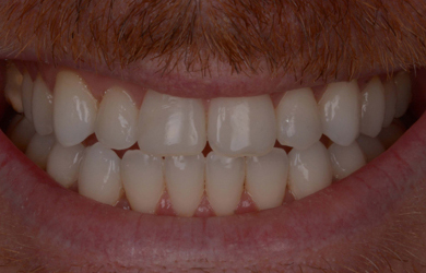 Invisalign & Whitening