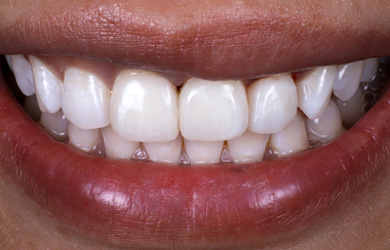 Composite Bonding